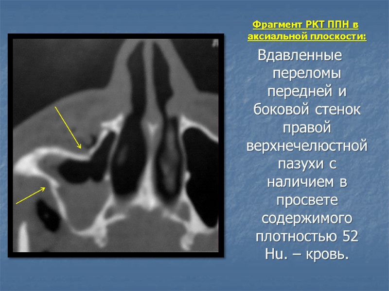 Фрагмент РКТ ППН в аксиальной плоскости: Вдавленные переломы передней и боковой стенок правой верхнечелюстной